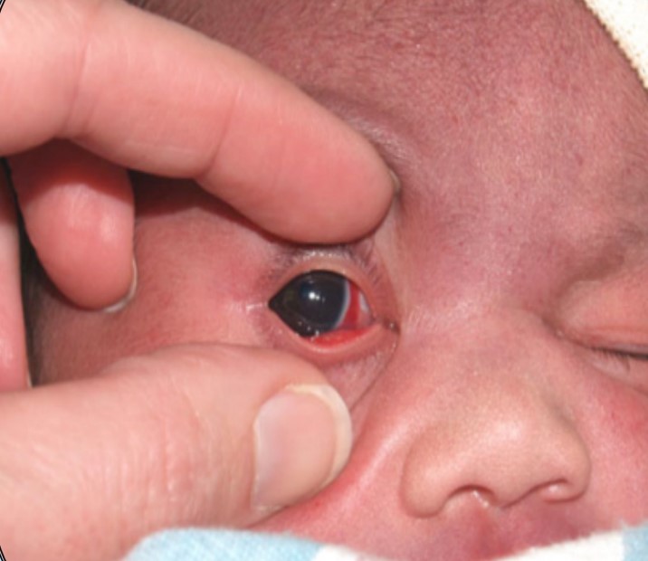 Not to worry - These are normal in a newborn