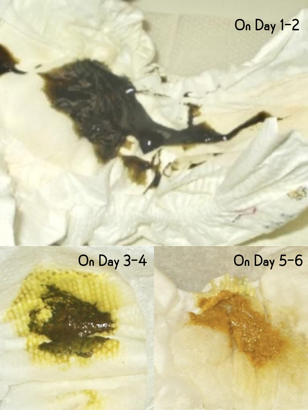 Understanding Your Baby's Urine and Stool Patterns